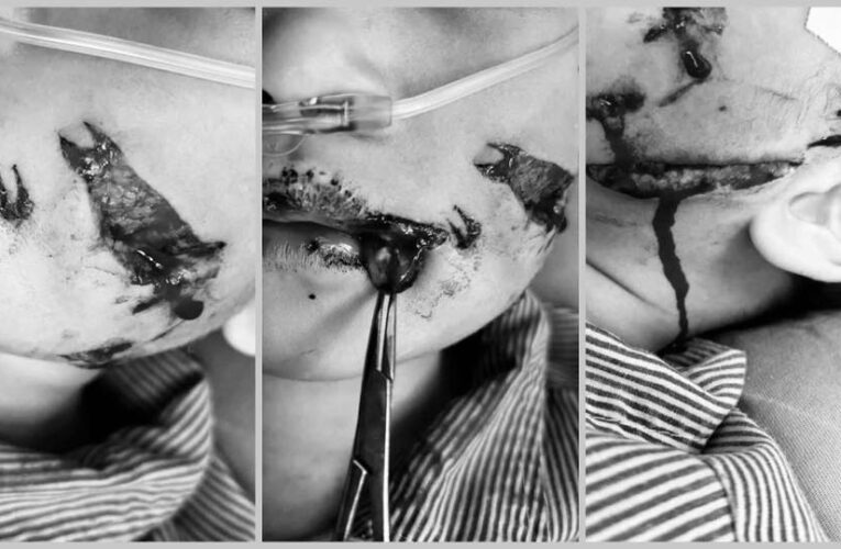 Cận cảnh bé 5 tuổi Bắc Giang bị ch.ó c.ắn vùng mặt