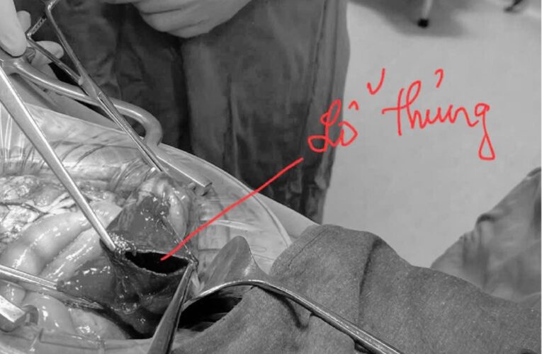 Dùng vòi rửa xe ô tô xịt vào hậu môn thanh niên Lạng Sơn thủng đại tràng
