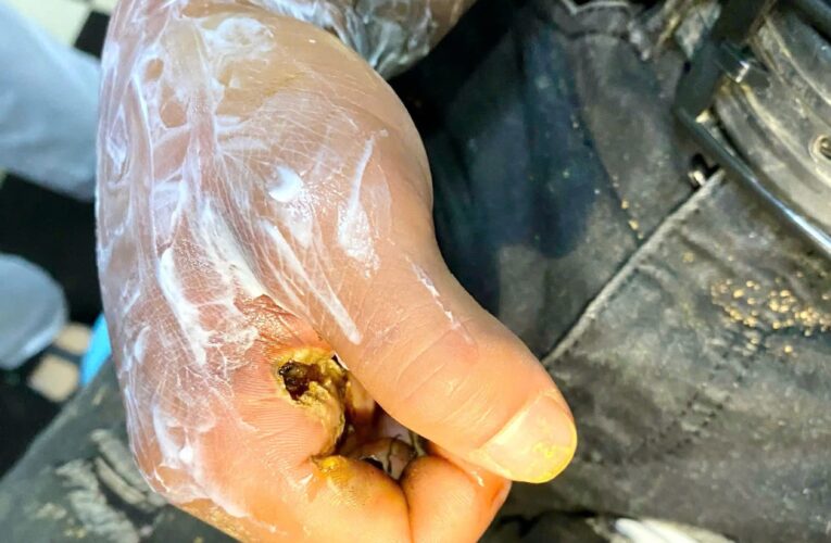 [VD] Lạng Sơn thanh niên đi câu cá bị điện gi.ật thương nặng